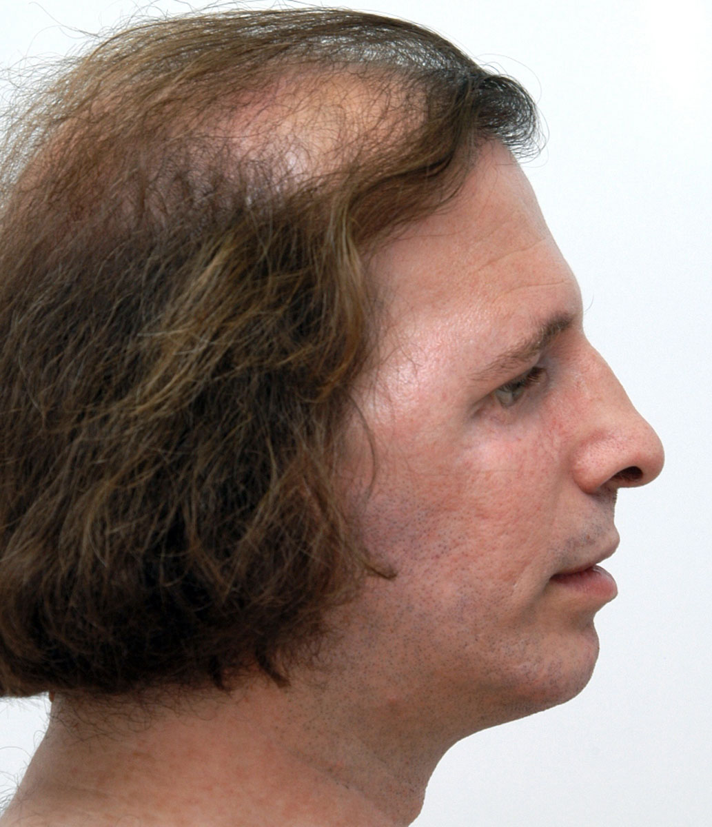 treacher-collins-syndrome-hellenic-craniofacial-center