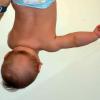 Positional plagiocephaly. Observe muscle spasm of the neck muscles