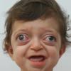 Crouzon syndrome with severe exophthalmos