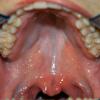 Submucous cleft. Bifid (double) uvula is observed.