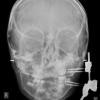 Κεφαλομετρική ακτινογραφία που δείχνει τη συσκευή τοποθετημένη
