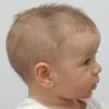 Scaphocephaly, preoperative appearance