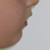 Obstructive apnea with micrognathia (small lower jaw)